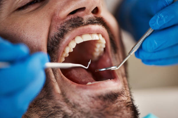 Best Emergency Tooth Extraction in Elmira, NY