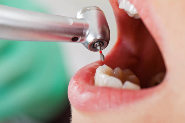 Best Emergency Wisdom Teeth Removal in Elmira, NY